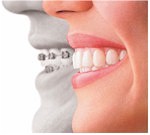 Invisalign